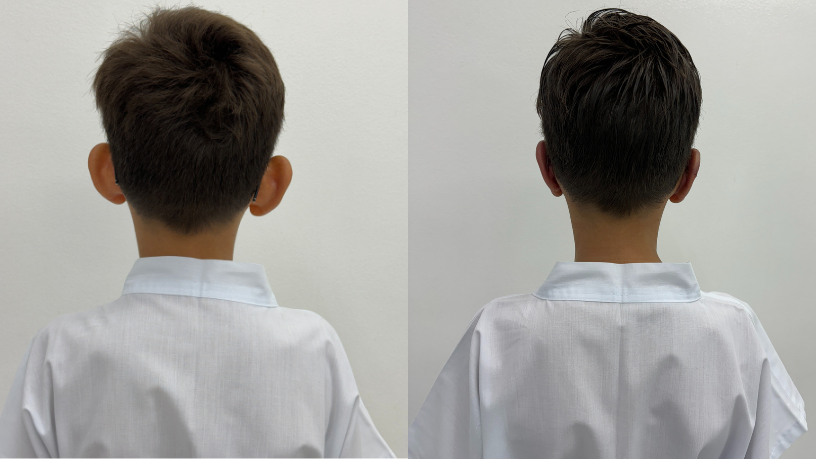 Entenda com Dr. Milton Seigi Hayashi a importância do diálogo familiar antes da cirurgia de orelha em abano.
